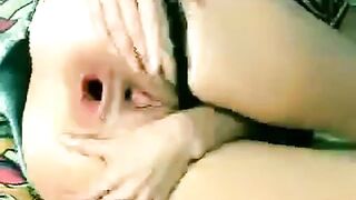 Webcam Girl Demonstrates Anal Prolapse